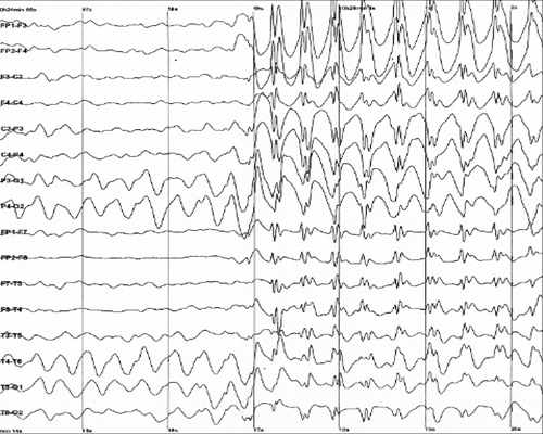 EEG electroencefalograma